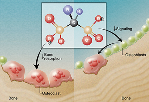 Bisphosphonate signals osteoclasts and osteoblasts, 