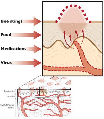 Hives formation, hives causes, hives