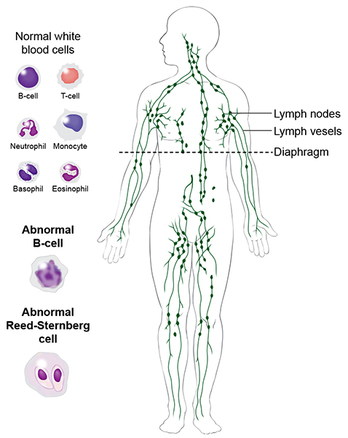 Hodgkins lymphoma, Non-Hodgkins lymphoma, blood cancer, hematologic cancer, Reed-Sternberg cell